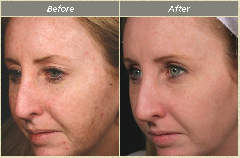 Фраксель для лица до и после Fraxel Treatments F08