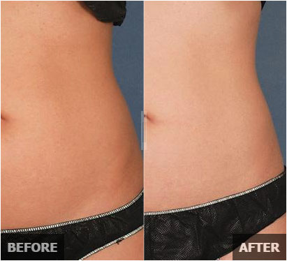 Liposonix - Before and After Pic