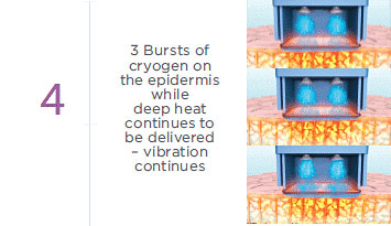 Thermage CPT Treatment - Step 4