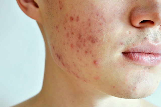 Dealing with Adult Acne