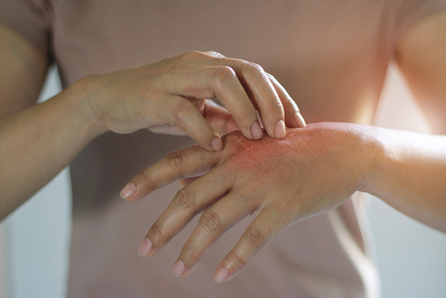 Dry, itchy skin and eczema treatment in Flower Mound, TX